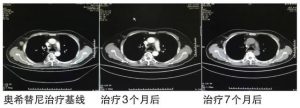 从典型病例看AZD9291的实际疗效。